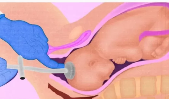 MP denúncia médico acusado de causar morte de bebê: 